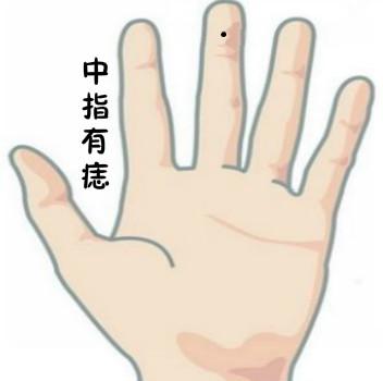 手指上有痣图解:手指上有痣代表什么意思,手指上有痣是什么意思