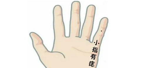 右手小拇指上长有痣代表什么,右手小拇指上长有痣代表什么预兆