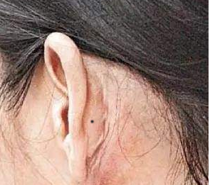 耳背有痣代表什么