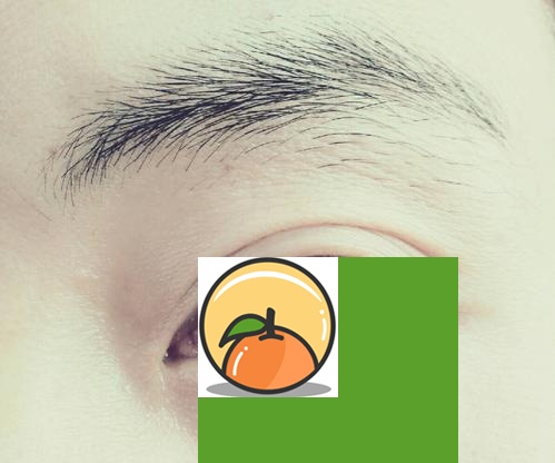 下睫毛下眼睑的位置有痣代表什么？ 眼睑痣